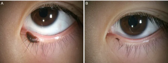 Figure 2. Recurrent compound nevus. (A) Preoperation. (B) 4 months after operation.