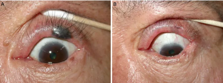 Figure 3. Postoperative trichiasis of patient with compound nevus. (A) Preoperation. (B) 5 months after operation.