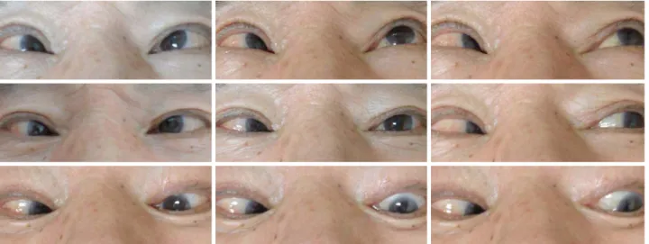 Figure 1. Preoperative nine cardinal photographs showing approximately 75 prism diopters of right  esodeviation (center) and limi-limi-통해 내사시 감소와 술 후 합병증의 발생 빈도를 줄일 수 있음을 보고하였다.저자들은  우안  외향신경마비로 75프리즘디옵터  이상의 심한 내편위가 있는 환자에서 우안 내직근 후전술 및 근절단,  근분리 없이 단순결찰만