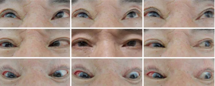Figure 4. Postoperative 1 week nine cardinal photographs showing straight alignment in primary position and improved abduction  of right eye