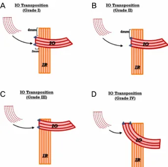Figure 1. Schematic diagram showing IO placement in four  grades (right eye, viewed from below)