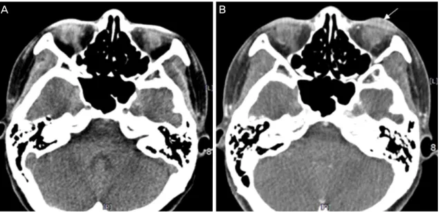 Figure 2. Computed tomography (CT) image. (A) Axial enhnaced CT scan reveals no significant abnormal lesion in the both lower  lid area at resting state
