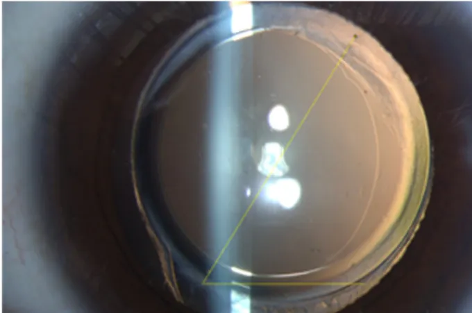 Figure 1. Image analysis for the rotation of the cylindrical  axis on the toric intraocular lens.