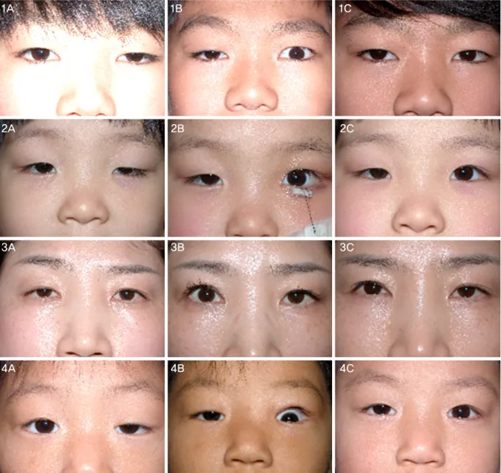 Figure 2. Photographs of patient 1 (1A-1C), 2 (2A-2C), 3 (3A-3C) and 4 (4A-4C). (1A, 2A, 3A, 4A) Before the operation of levator  resection