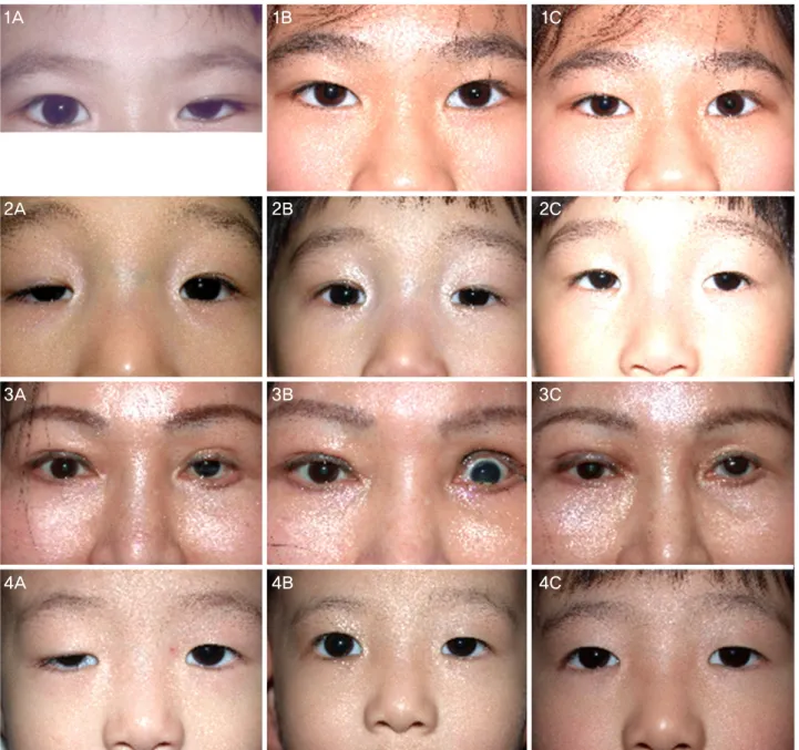 Figure 3. Photographs of patient 5 (1A-1C), 6 (2A-2C), 7 (3A-3C) and 8 (4A-4C). (1A, 2A, 3A, 4A) Before the operation of levator  resection