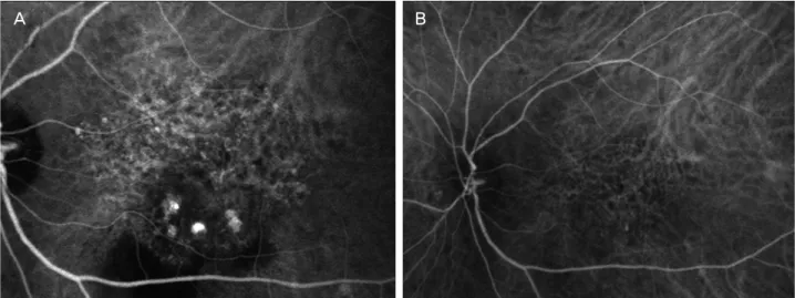Figure 5. Case No. 5 (A) Baseline ICGA shows polypoidal dilatation of choroidal vessels and branching vascular network