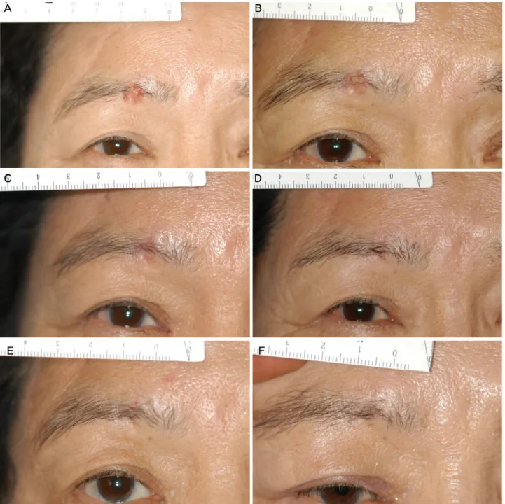 Figure 2. External photography after medication. (A) Post-medication photo: at 1 week after starting 5% Imiquimod cream