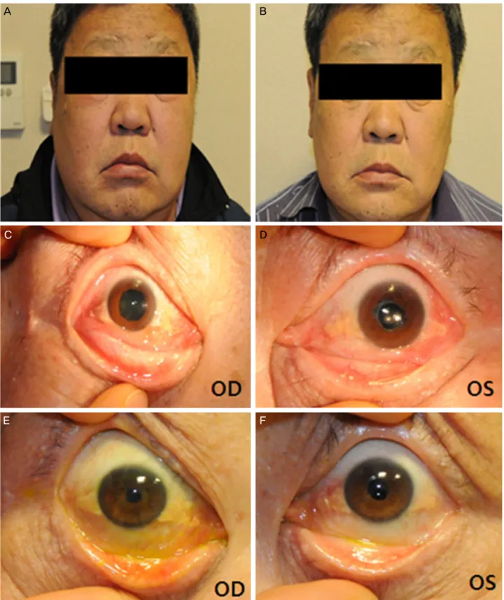 Figure 1. Face and anterior segment photograph before and after percutaneous transluminal angioplasty