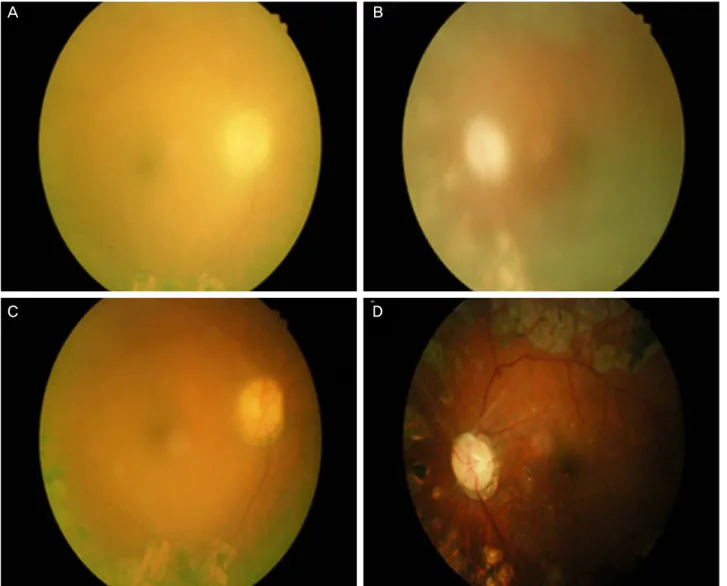 Figure 2. The changes of fundus photography according the changes in intraocular pressure