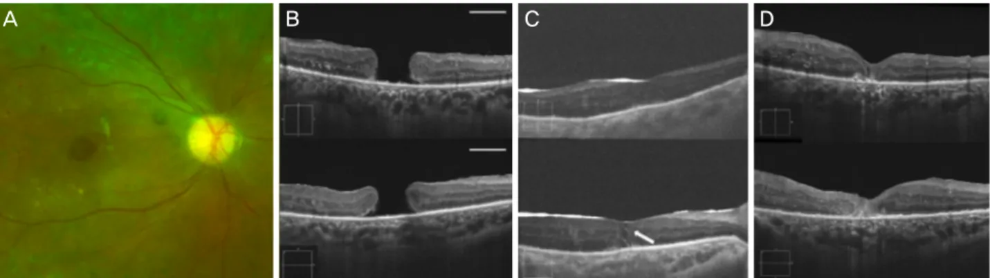 Figure 2. A case of full thickness macular hole (MH) in 52-year-old female. Preoperative color fundus photograph (A) and OCT (B,  horizontal white line: 1 mm scale bar) of the right eye demonstrated diabetic retinopathy and large macular hole