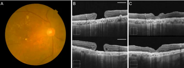 Figure 4. A case in 76-year-old male. Preoperative color fundus photograph (A) and optical coherence tomography (OCT) (B, hori- hori-zontal white line: 1 mm scale bar) showing the multiple soft drusen and the large macular hole