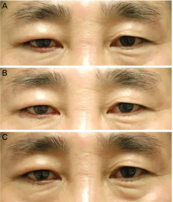 Figure 1. Changes of mass of right eyelid. (A) Photograph of  the patient at initial visit