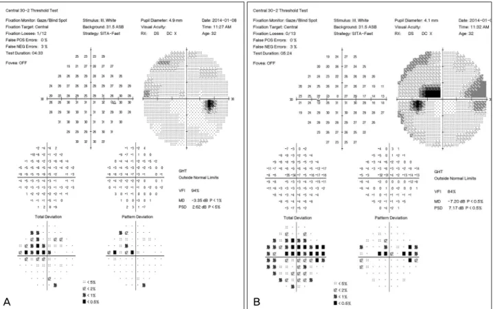 Figure 4. Humphrey visual field testing of both eyes. Superior nasal steps and paracentral scotomas are found in both eyes