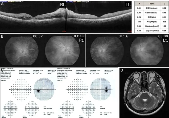 Figure 2. Optical coherence tomography, fluorescein angiography and perimetry of the both eyes and brain MRI