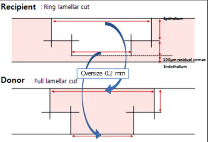 Figure 1. Settings on the FSL to create a partial-thickness  mushroom configuration in the recipient and doner cornea  as-suming a minimum corneal pachymetry of 550 mm
