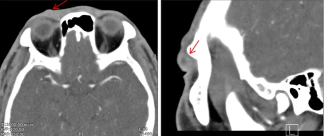 Figure 2. Computed tomography scan showed a hypo-dense, non-enhancing, focal round mass measuring 7.0 × 9.0 × 9.5 mm on the right upper eyelid (arrow).