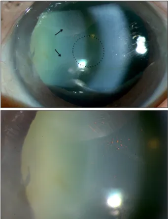 Figure 1. Anterior segment photos of the left eye shows prom- prom-inent long anterior lens zonules (black arrows) causing a  zon-ule-free zone (dotted circle) only 2.5 mm in diameter