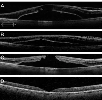 Figure 3. (A) Preoperative OCT shows retinoschisis and se- se-rous retinal detachment at the macula