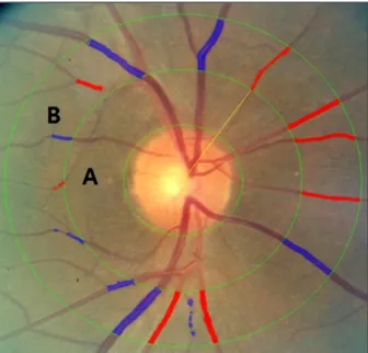Figure 1. Measurement of retinal vessel diameter. Zone A is  0.5 disc diameters from the optic disc margin, and Zone B is  0.5 to 1 disc diameter from the optic disc margin