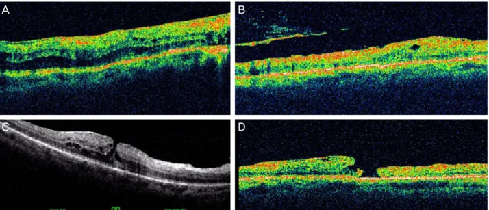 Figure 2. Serial optical coherence tomography of macular hole  formation due to macular thinning 1 months (A) and 6 months  (B) after primary vitrectomy