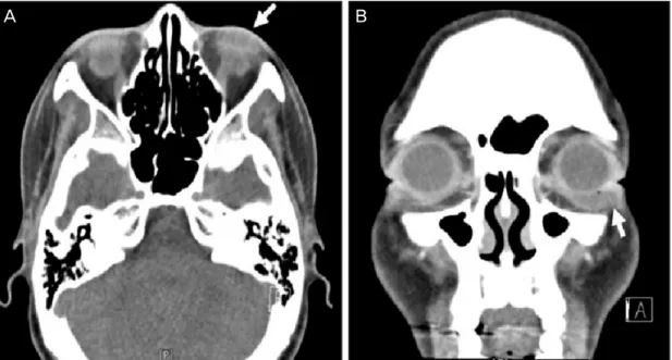 Figure 2. Axial (A) and coronal (B) view enhanced computed tomography images demonstrate 1.5 × 0.8 cm sized  ovoid shaped cystic mass (white arrow) in anterior–inferior part of the left orbit