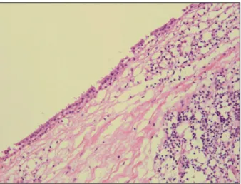 Figure 3. Microscopic appearance of the cyst lined by non-keratinized stratified squamous epithelium with chronic inflammation (H&amp;E,
