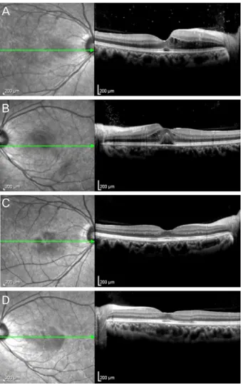 Figure 2. (A, B) Fluorescein angiography (left column) re- re-vealed late hyperfluorescence of the arterioles of the macula in  left eye
