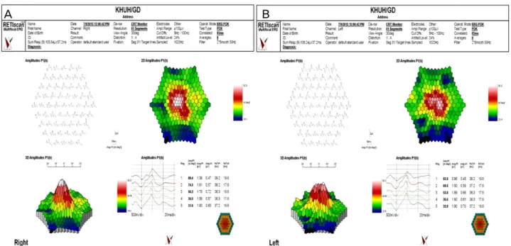 Figure 5. (A, B) Six weeks after the first visit, corrected visual acuity improved to 1.0 in the both eyes