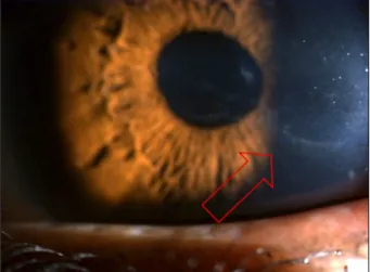 Figure 3. Cystic form in PPMD on slit lamp exam.