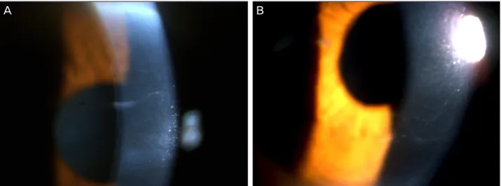 Figure 4. Linear form in PPMD on slit lamp exam. 이 질환에 의한 각막부전으로 각막이식을 시행 받은 경 우는 1건이었다