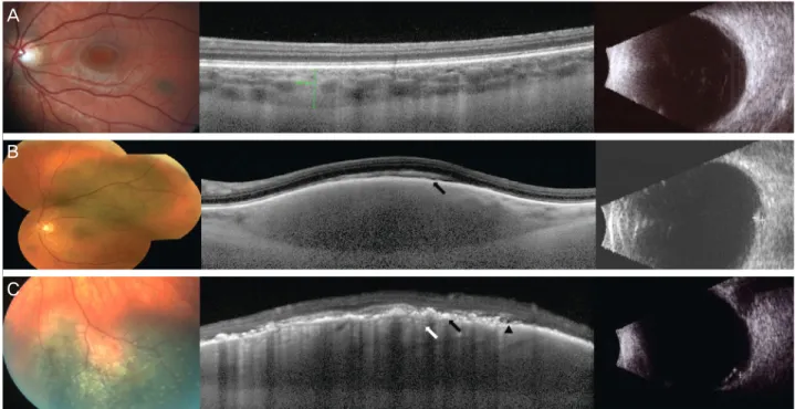 Figure 1. Color fundus photograph (FP), EDI-OCT and BUS of choroidal nevi. (A) FP showing pigmented choroidal nevus