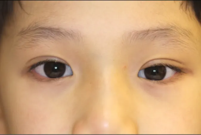 Figure 1. Pleomorphic adenoma in a 7-year-old boy who had  experienced proptosis and upper eyelid ptosis of left eye for 2  months.눈물샘 여러형태샘종은 눈물샘에 발생하는 양성 종양 중 가장 흔한 종양으로서 상피 및 중배엽성 기원의 세포들이 함께 나타나는 것이 특징적이다