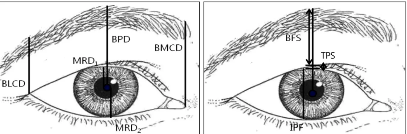 Figure 1. Schematic picture of the clinical parameters for the brow position measured in this study