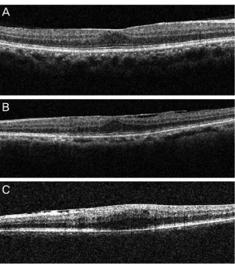 Figure 1. Classification of the inner segment/outer segment  (IS/OS) junction of the photoreceptor layer according to  opti-cal coherence tomography scan