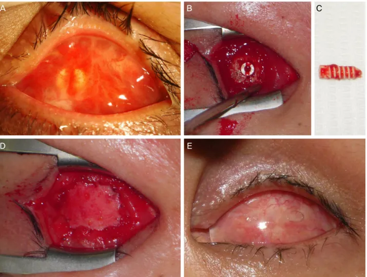 Figure 1. Case 1. (A) A large granuloma covers the entire anterior surface of conjunctival sac at initial presentation