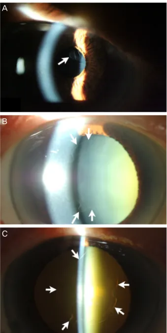 Figure 1. Slit lamp examination showing floating ring-shaped  fibrous membrane (arrows) in the anterior chamber in the right  eye (A) before dilation, (B) after dilation of the pupil, and (C)  with retroillumination