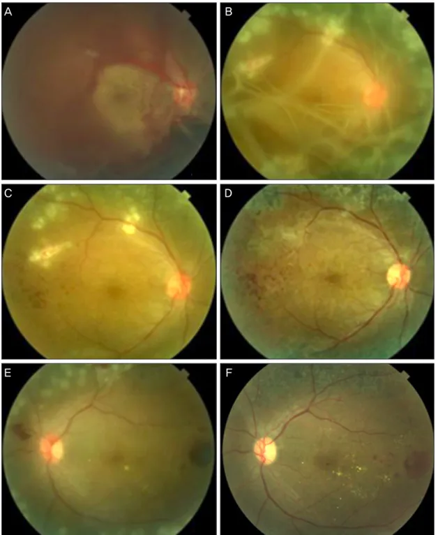 Figure 1. Vitreous hemorrhage is observed in the right eye (A). At postoperative day 1, multiple inflammatory  web-like white strands (vitreous web) are seen (B)