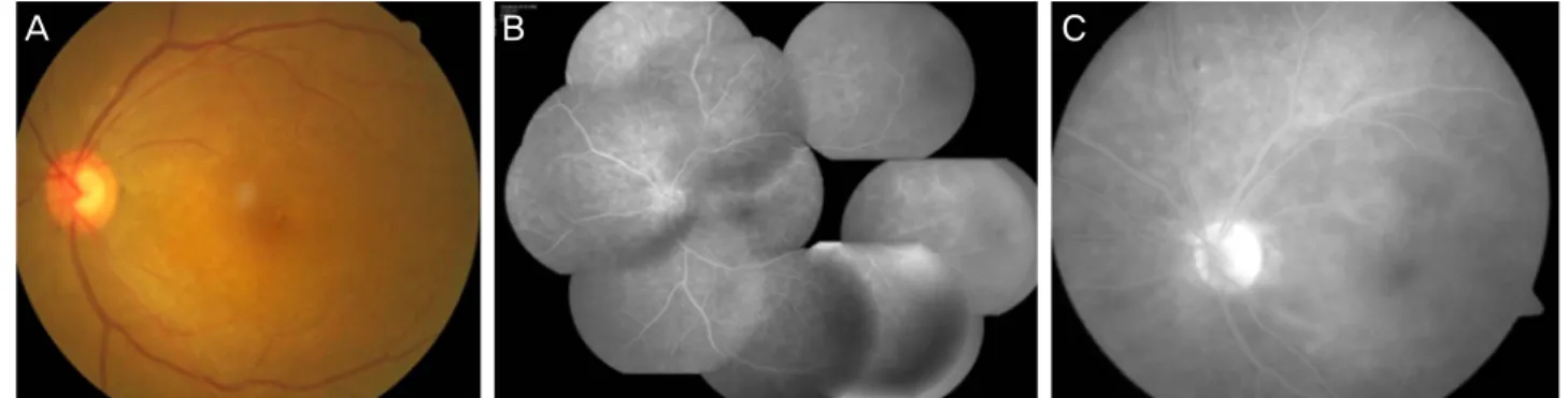 Figure 1. (A) Fundus phograph at presentation shows microaneurysms and subtle opaque of the macula at the initial visit