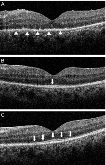 Figure 3. (A) Optical coherence tomography (OCT) shows dif- dif-fuse loss of signal from the photoreceptor inner/outer segment  (IS-OS) junction and the external limiting membrane (ELM),  and presumed inflammation signs including indistinct retinal  layers