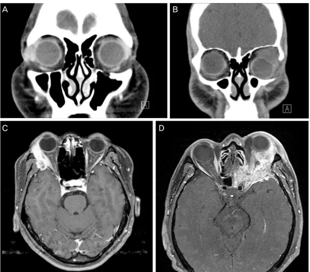 Figure 1. (A) Pleomorphic adenoma. CT shows a well-marginated round mass with isodensity in the Rt lacrimal  gland