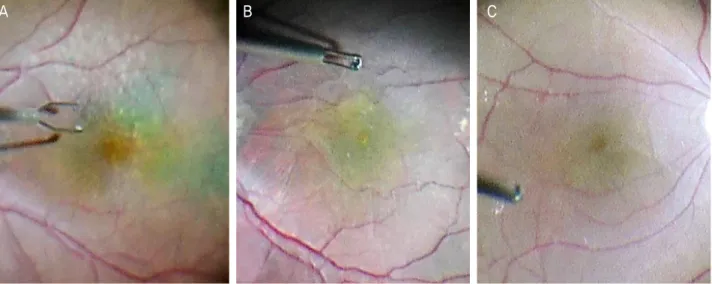 Figure 1. Surgeon’s view. Visual quality of the stained internal limiting membrane (ILM)