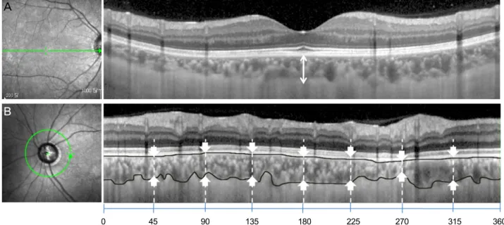 Figure 1. Images from spectral-domain optical coherence tomography (SD-OCT) with enhanced-depth imaging (EDI)