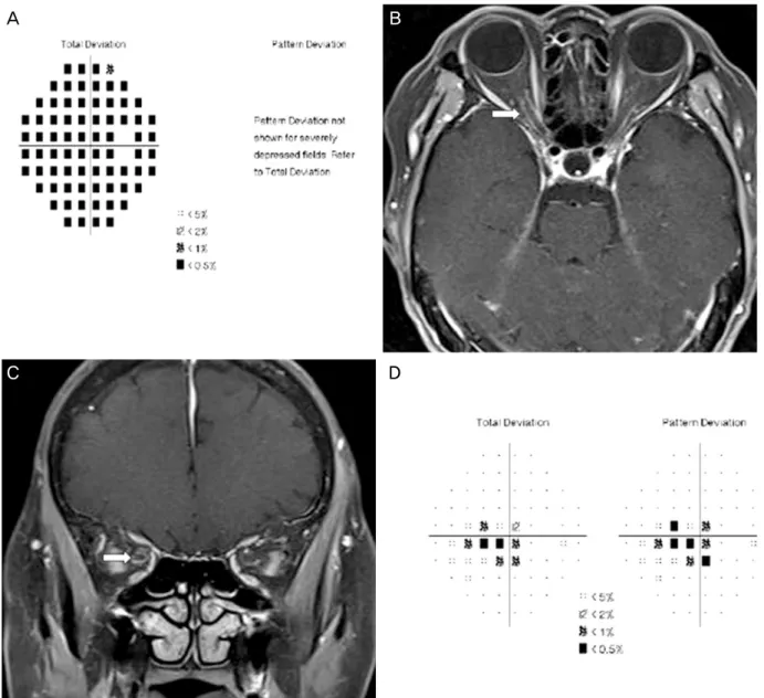 Figure 2. Right visual field test was seen diffuse visual field defect at initial visit (A)