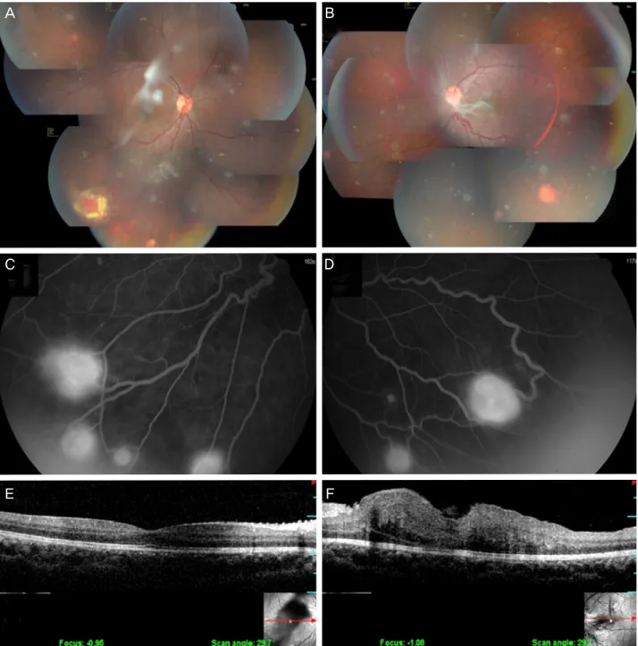 Figure 1. First visit (pre-treatment). (A, B) Multiple orange-red colored round masses <2.5 DD with afferent and efferent vessels  were observed at the peripheral retina in both eyes