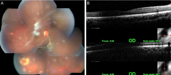 Figure 4. Fundus photography (A) and optical coherence tomogram (OCT) images (B). Exacerbated epiretinal membrane (ERM)  was noticed compared to the first visit