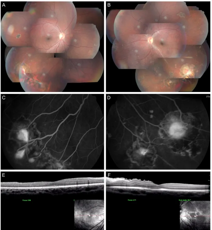 Figure 5. Last visit (18 months after left eye surgery, 15 months after right eye surgery)