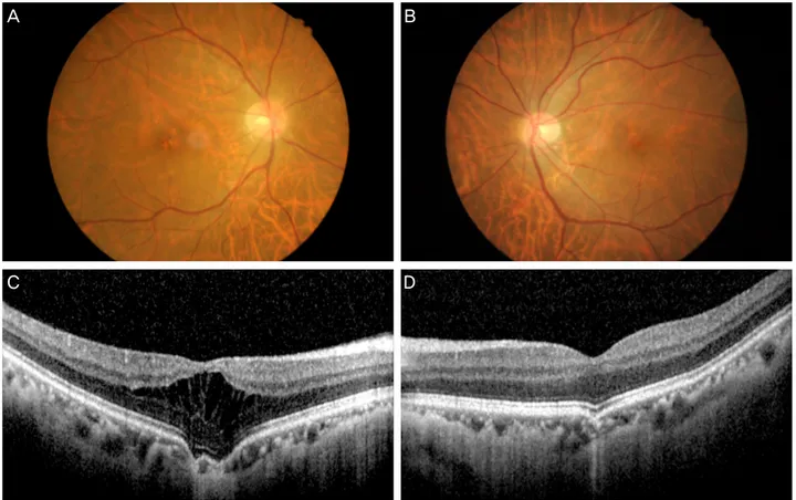 Figure 1. A 55-year-old man with high myopia. Color photographs of the right (A) and left (B) eyes show mild foveal retinal pig- pig-ment epithelial changes