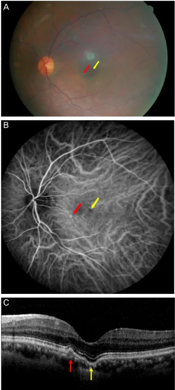 Figure 2. Fundus photography, indocyanine green angiography  (ICGA), spectral domain optical coherence tomography (SD-  OCT) images of a 56-year-old woman