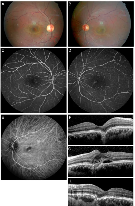 Figure 3. Findings in a 27-year-old man with bilateral focal choroidal excavation. Fundus photographs on the initial presentation  show pigmentary change at the parafovea in the right eye (A) and yellowish exudates lesion at the parafovea in the left eye (