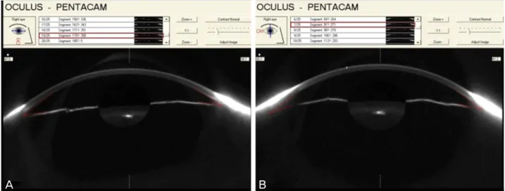 Figure 1. An example of the result of anterior chamber angle (ACA) measurement by Pentacam®